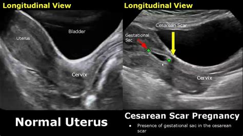 uterus scar size after cesarean section